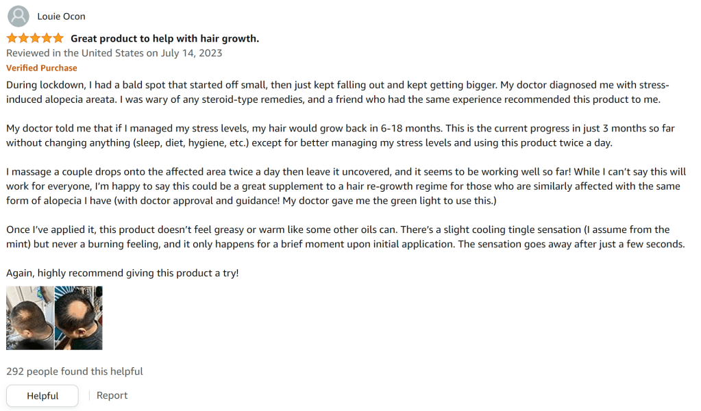 This rosemary oil treated my bald spot. After just 3 months, the bald spot is reduced significantly.