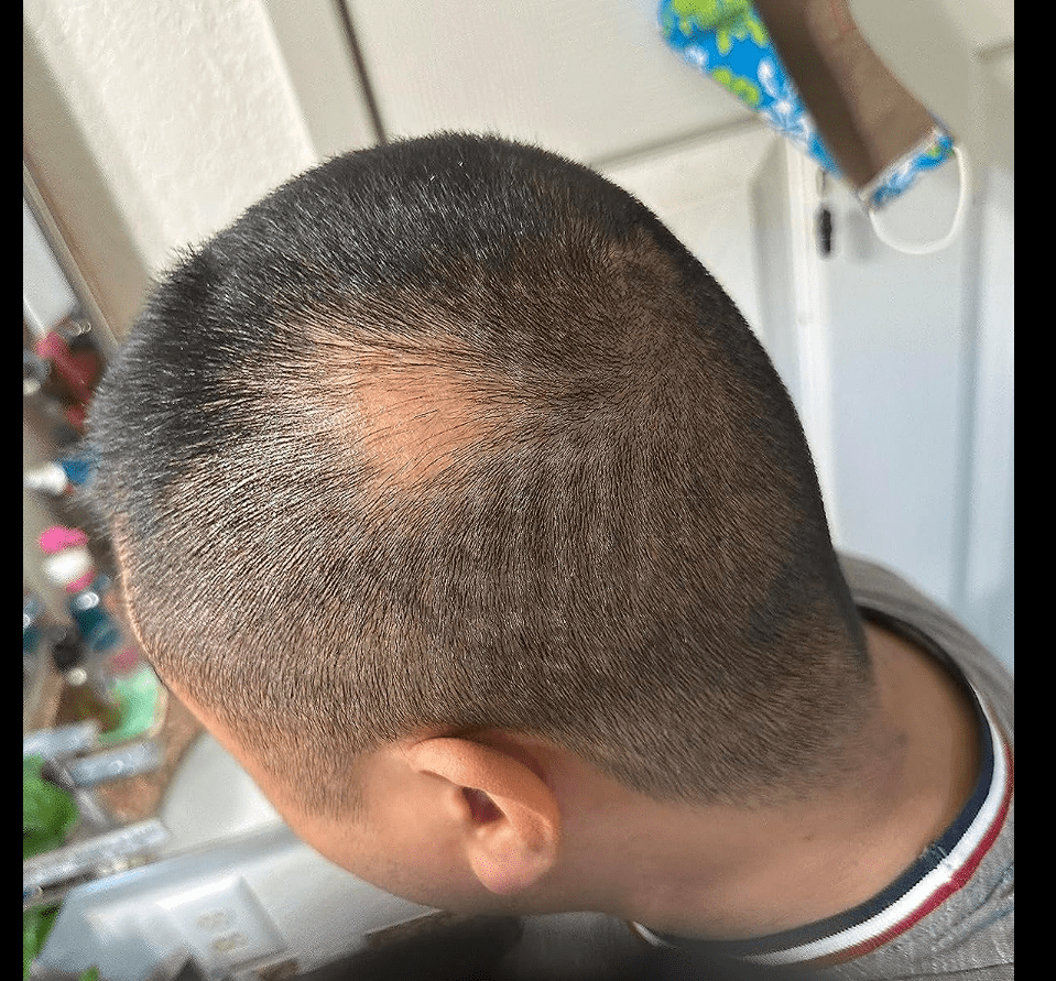 after image - the bald spot has regrown hair and nearly disappeared