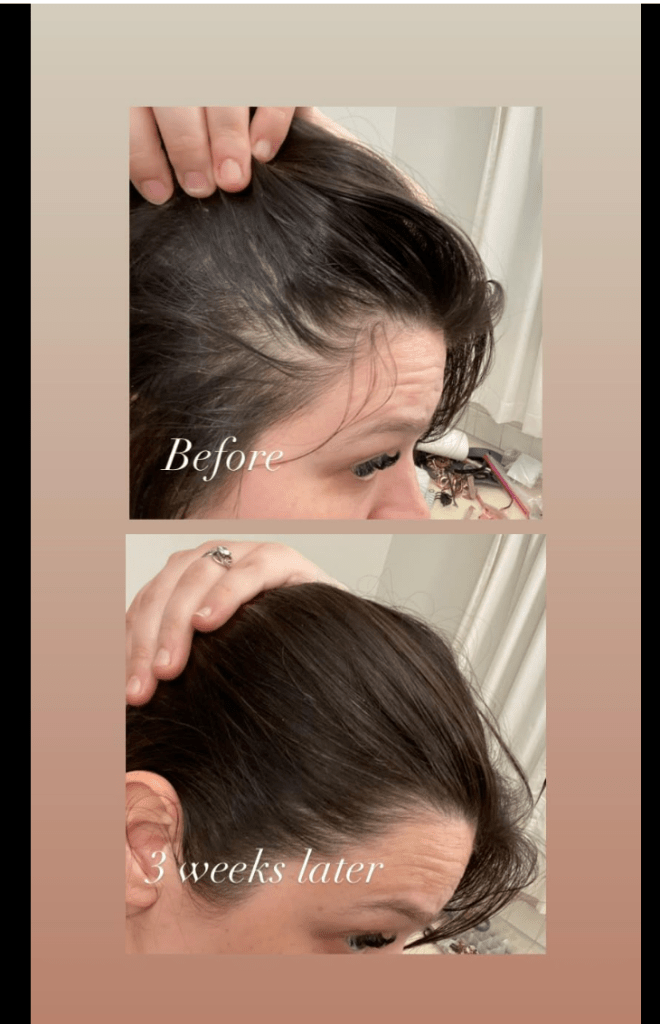 Impressive results from rosemary oil in 3 weeks. full, thicker hairline and healthier edges.