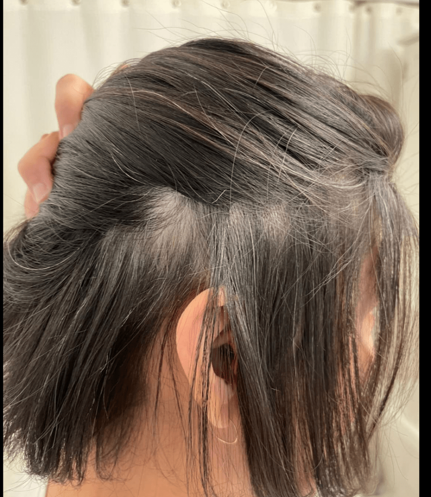 Alopecia areata bald spot with new hair growth, after picture with impressive results.