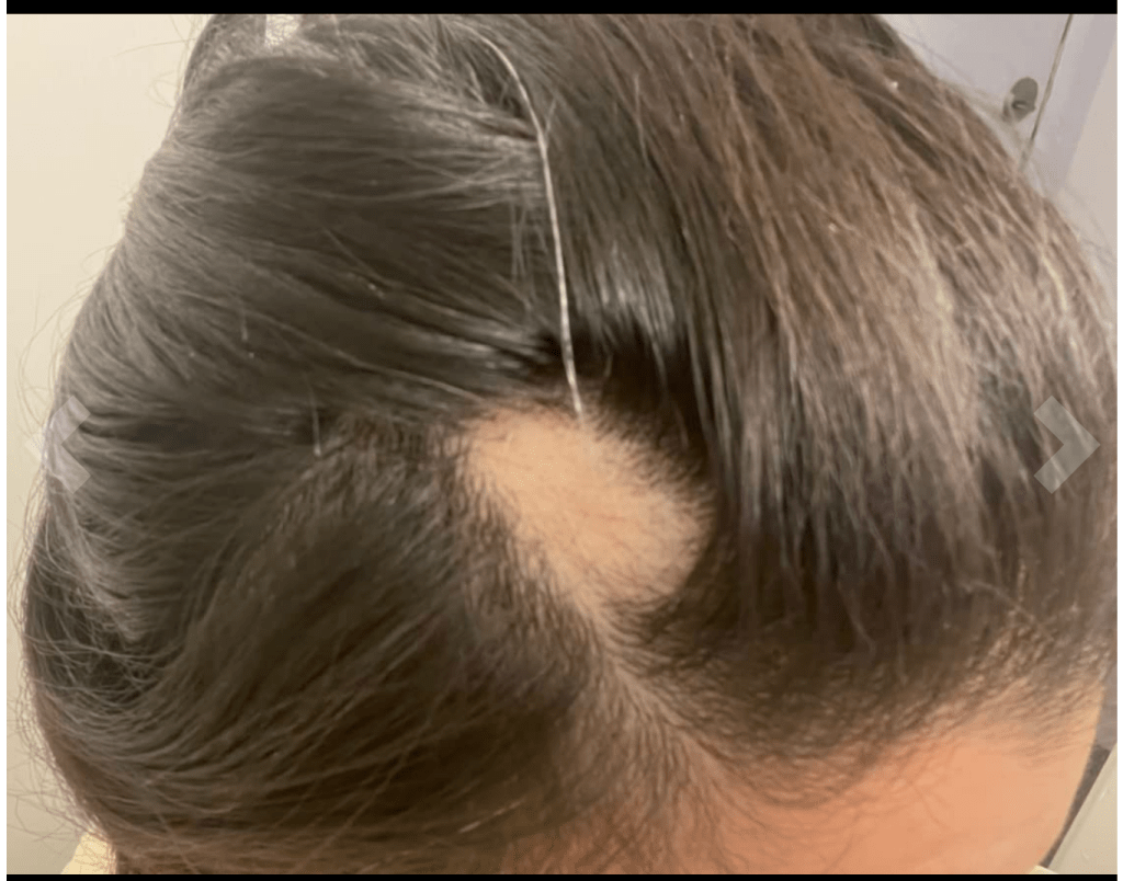 Alopecia areata bald spot on top of girl's head.