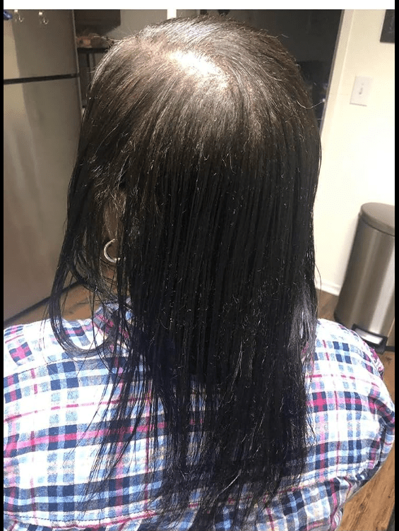 before image of thinning, unhealth hair.