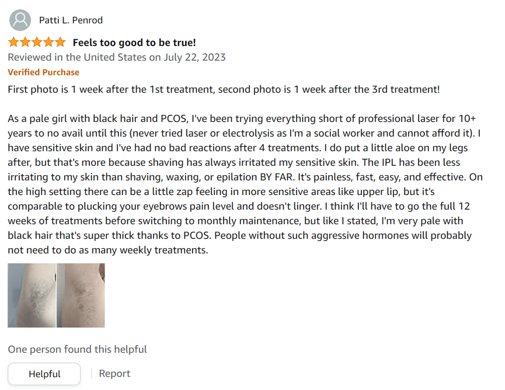 1 week after the third treatment, and I already see significant results!