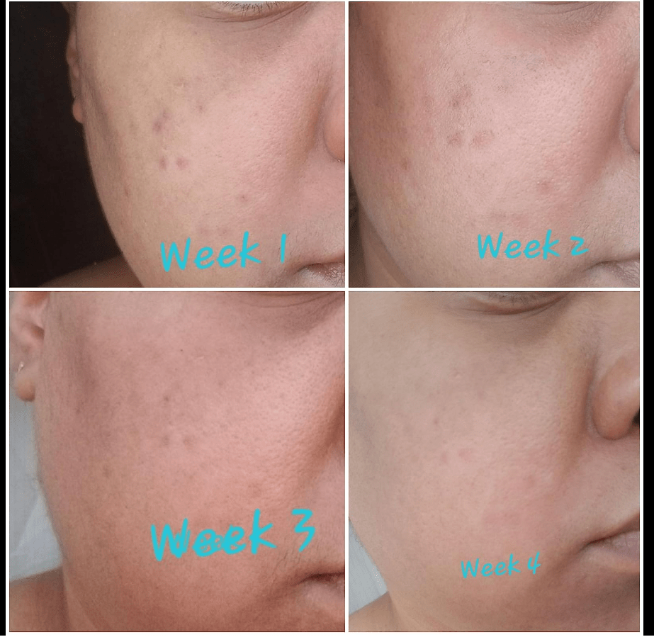 before and after pictures of glycolic acid's exfoliating abilities.